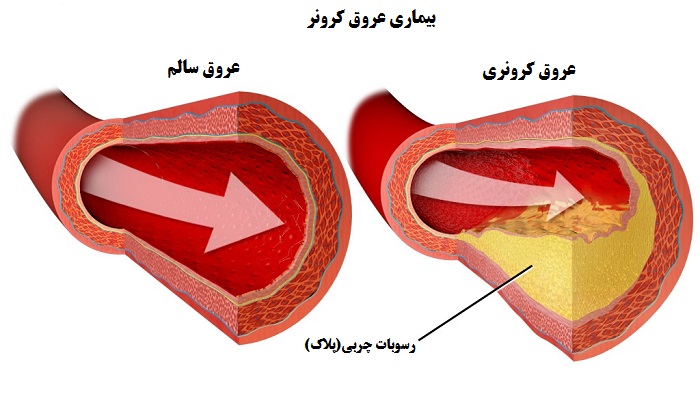 آنژیوگرافی