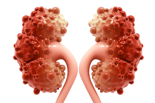 Chronic kidney failure