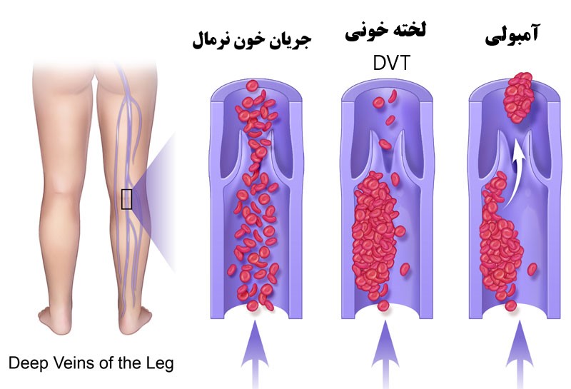 لخته خون در رگها