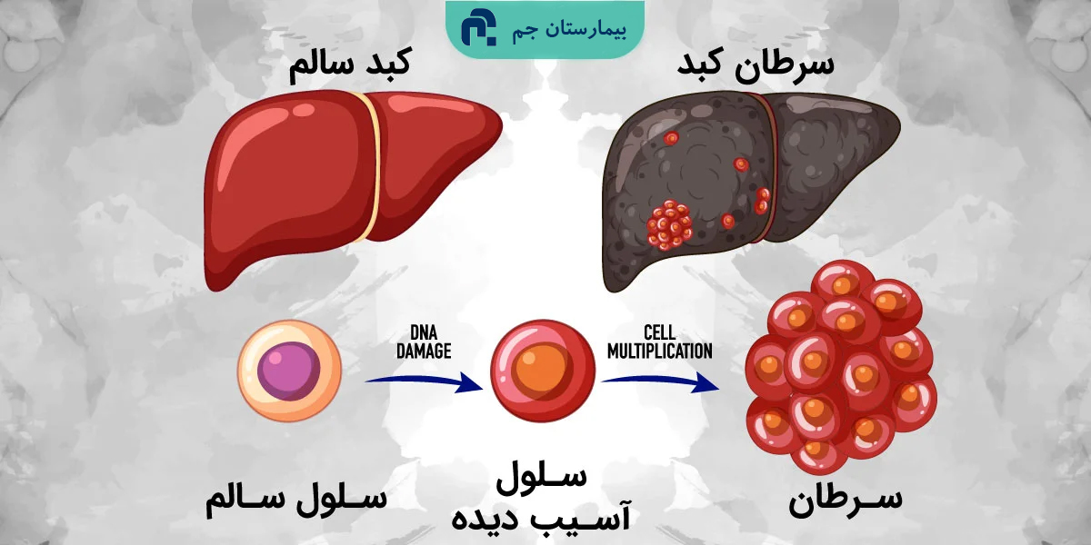 سرطان_كبد