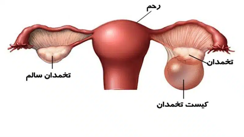 كیست_تخمدان