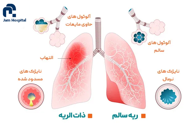 ذات_الریه