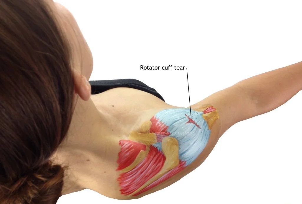 پاره شدن عضله روتاتور کاف