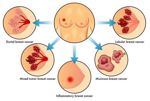 stages of breast cancer