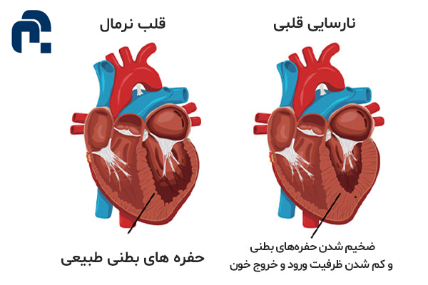 نارسایی قلبی