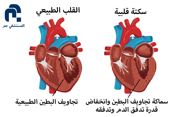 فشل_قلبي