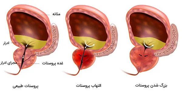 سرطان پروستات