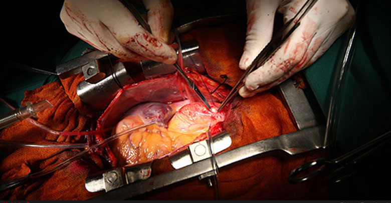 جراحي قلب باز